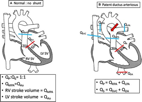 qp qs cath calculation.